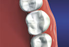 Natural looking materials are available to fill your teeth  Materials that mimic the color of natural teeth